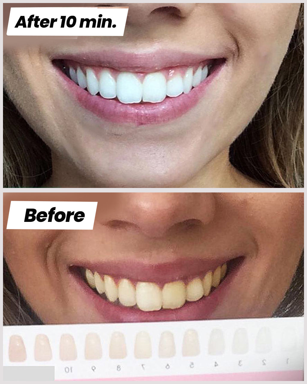 IO Teeth Whitening Kit™